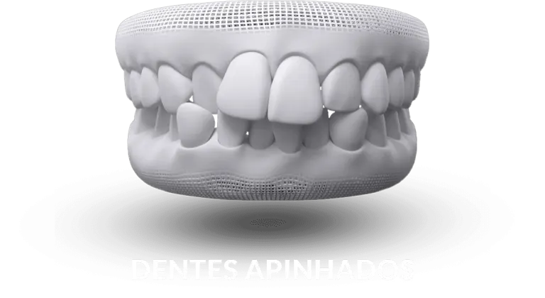 Ilustração de dentes apinhados