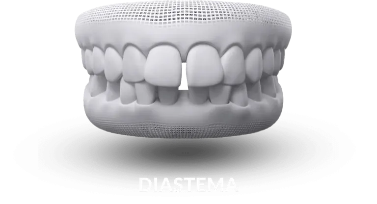 Ilustração de diastema, espaço entre os dentes