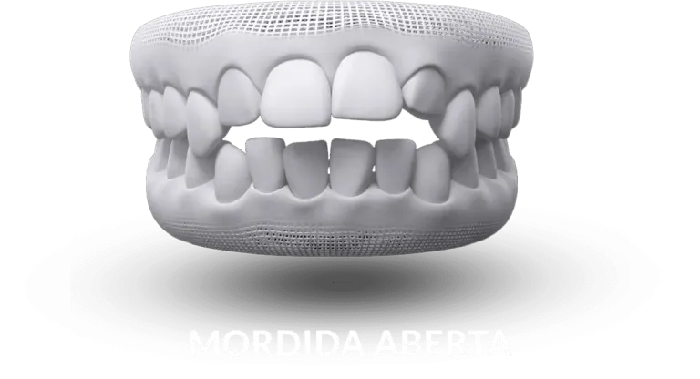 Ilustração de mordida aberta