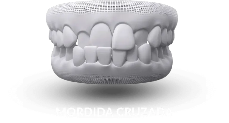 Ilustração de mordida cruzada