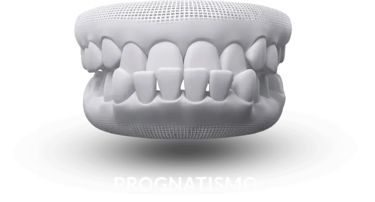 Ilustração de prognatismo