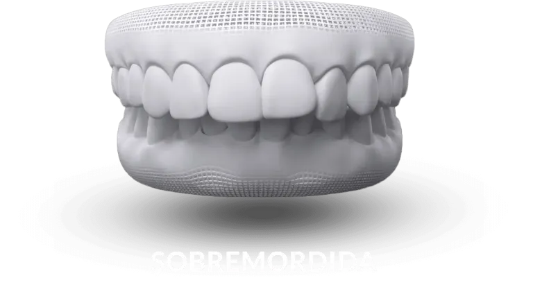 Ilustração de sobremordida